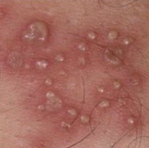 <p>a small, elevate lesion <1cm in diameter that contains serous fluid</p>