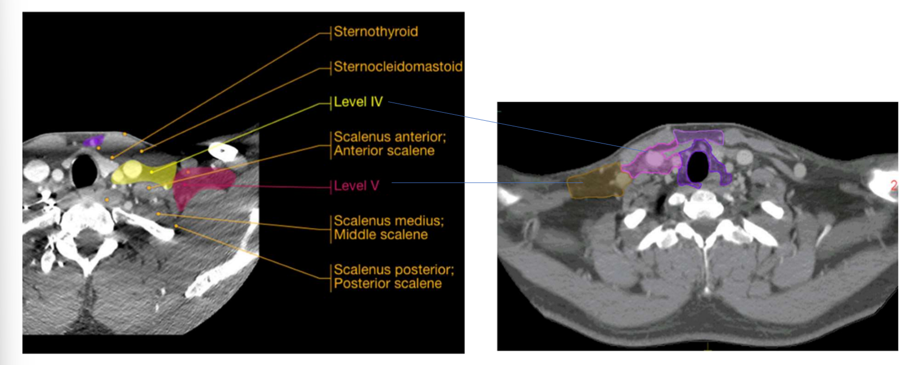 <p>what is the sup and inf border of level V - posterior triangle group</p>