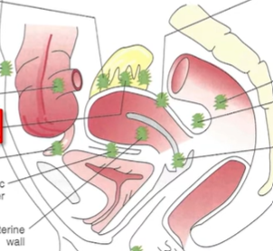 <p>In the cul de sac (in between uterus and colon posteriorly, due to gravity) and the left side of the pelvis, due to sigmoidal colon blocking the ectopic cells from travelling any further. </p>