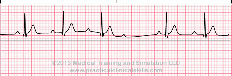 <p>Rate: depends on underlying rhythm </p><p>Regularity: irregularly irregular </p><p>Longer, longer, longer, drop </p>