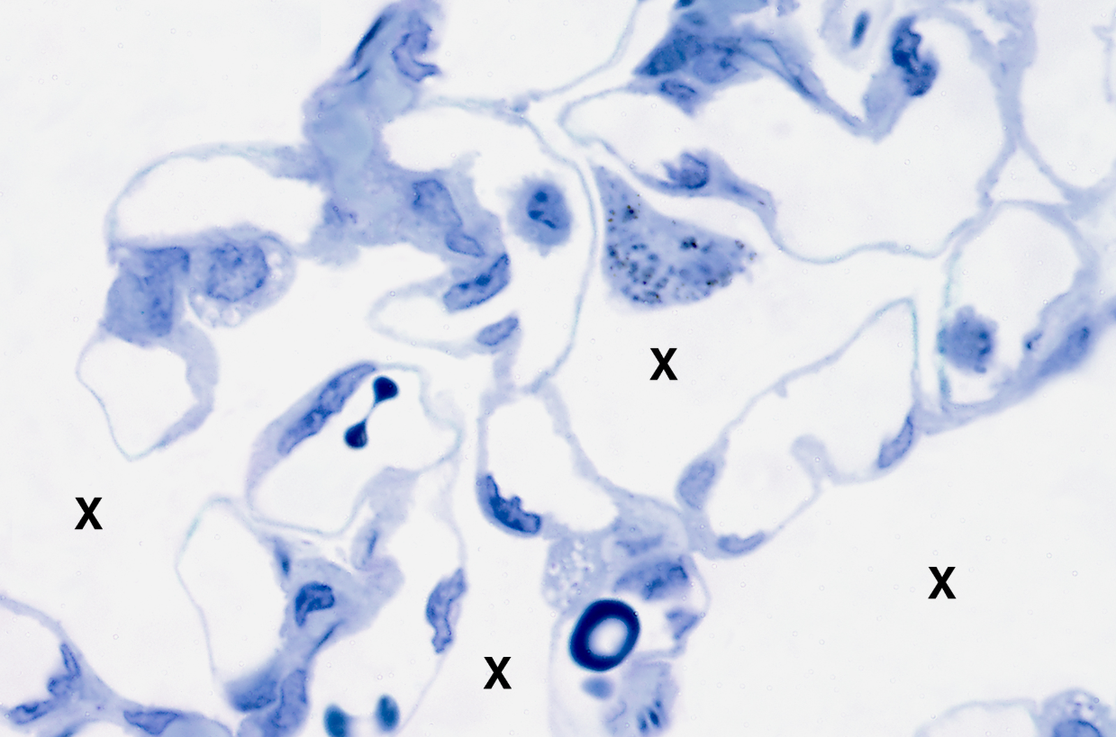 <p>Lung tissue</p><p><strong>NOTICE: THE OPEN SPACE OF THE ALVEOLI</strong></p>