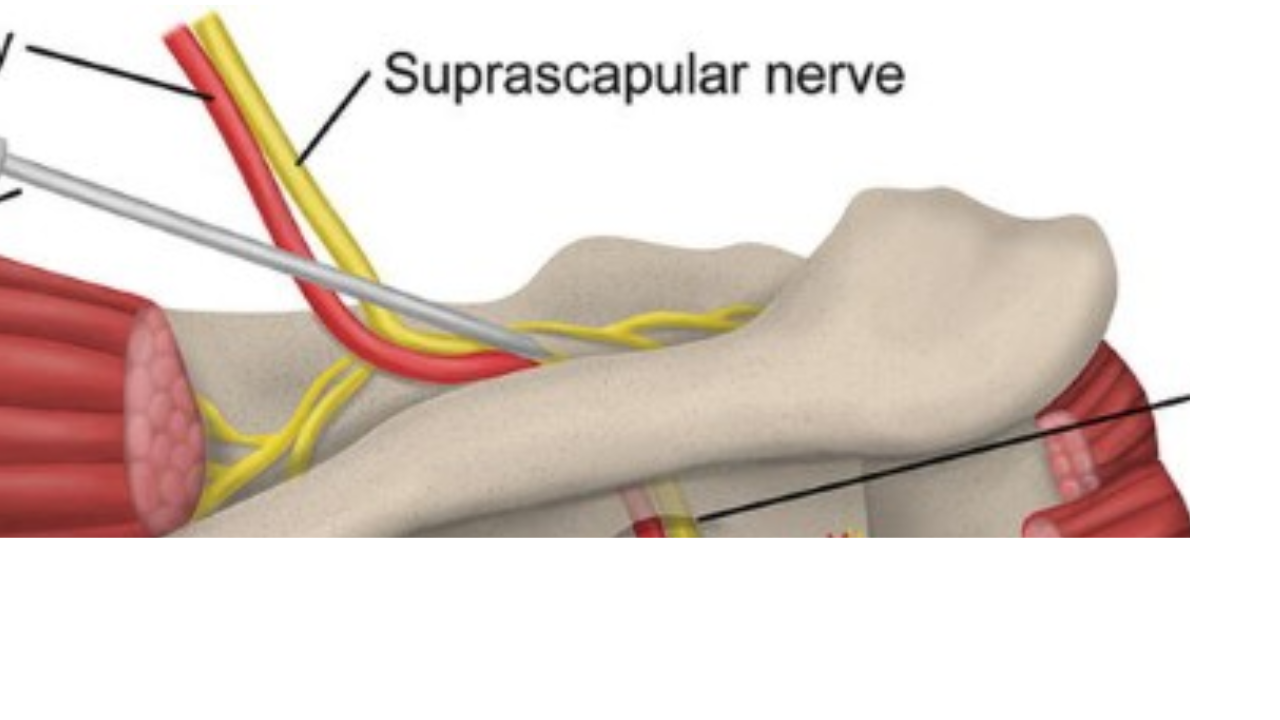 <p>Suprascapular Nerve</p>