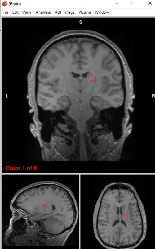 <p>basal ganglia/thalamus</p>