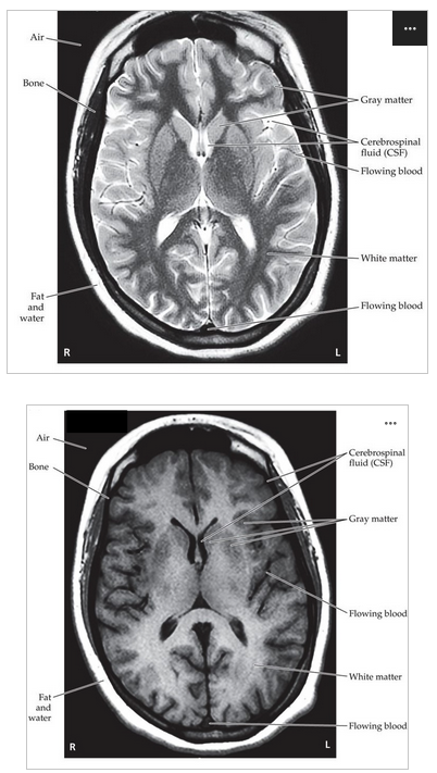 <p><span>1) What type of brain scans are pictured above?</span></p><p><span>2) Which one is T1-weighted? Which one is T2-weighted?</span></p>