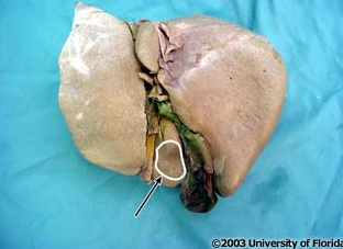 <p>what impression is being highlighted on the liver?</p>