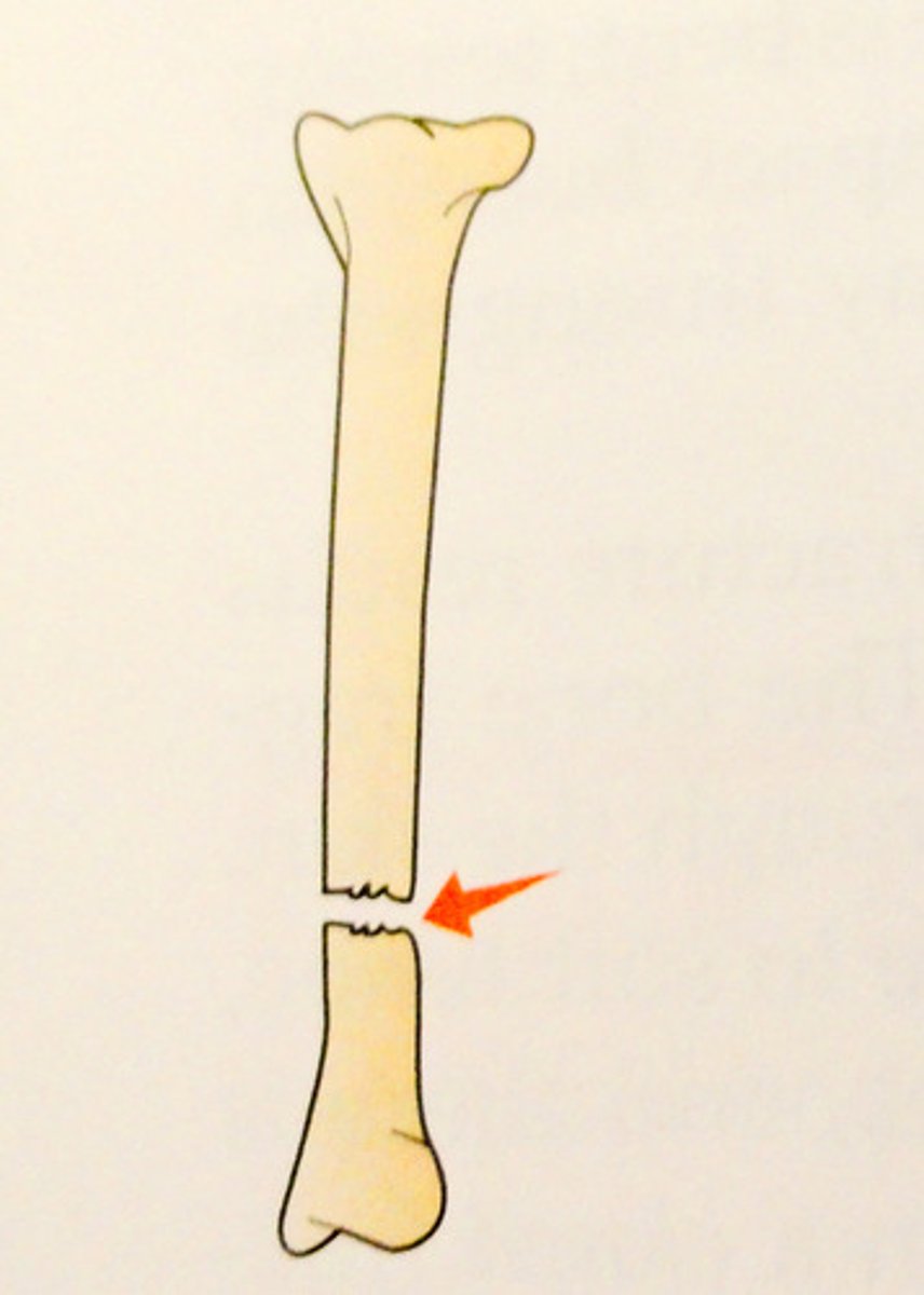 <p>complete fracture that is straight across the bone</p>