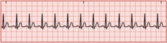 <p>Heart rate is greater than 100/min</p>