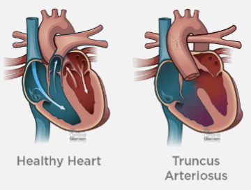 <ul><li><p>only <span style="color: red;">one great artery arises from base of the heart</span></p><ul><li><p>pulmonary, coronary, and systemic arteries arise from common root</p></li></ul></li><li><p><span style="color: red;">VSD typically present</span></p></li><li><p>can mimic ToF with pulmonary atresia</p></li><li><p>too much blood may be sent to lung</p><ul><li><p>extra fluid may build up in/around lungs</p></li><li><p>blood vessels to lungs become damaged (pulmonary hypertension)</p></li></ul></li><li><p>surgical intervention is required</p></li><li><p>poor prognosis if left untreated</p></li></ul><p></p>