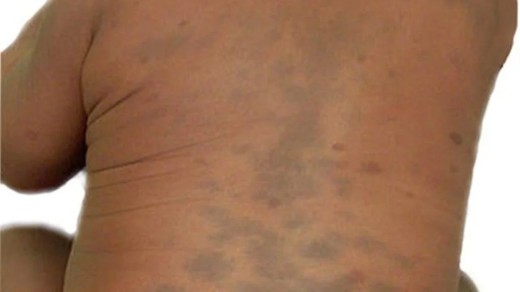 <p>dark spots (blue, black, or purple) on an infant after birth that normally fade</p><ul><li><p>caused by melanin being trapped deeper in the skin</p></li><li><p>more common in Black, Asian, Latino, and Native American babies</p></li><li><p></p></li></ul><p></p>