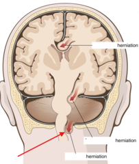 <p>What kind of herniation is this?</p>