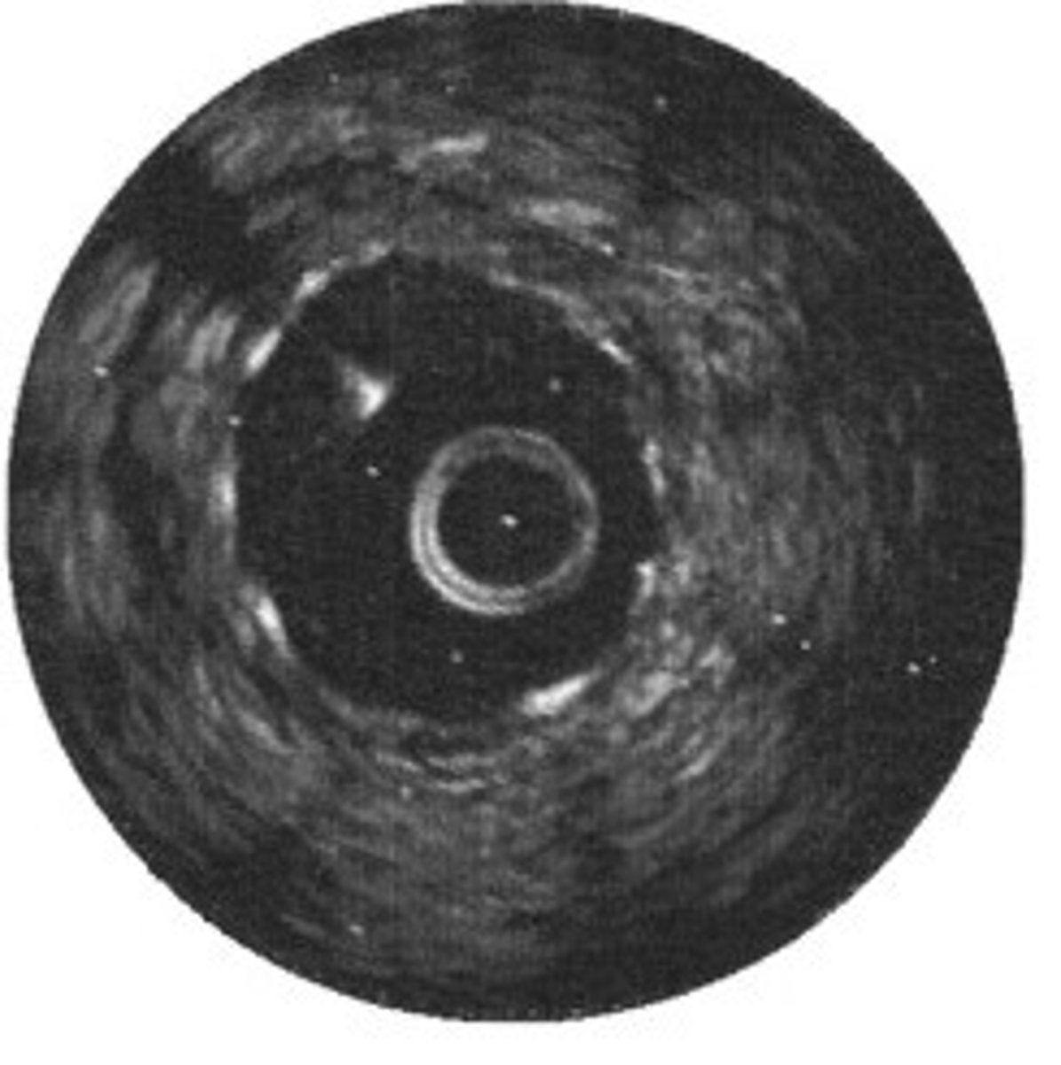 <p>This stent is not fully apposed</p>