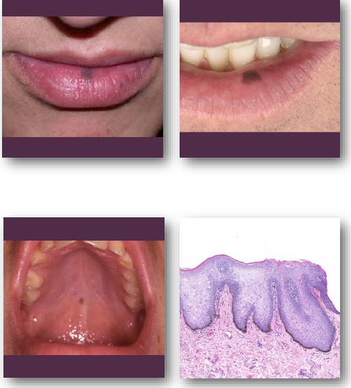 <p>• <strong>Flat well-defined brown mucosal macule</strong></p><p>• Usually solitary and uniformly pigmented</p><p>• Typically, less than 7 mm in greatest size</p><p>• <strong>Common on lip, gingiva, and buccal mucosa</strong></p><p><strong>• Color remains stable over time</strong></p>