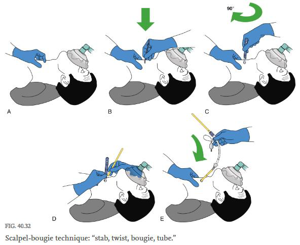 <p>답: C vs D (CTM 하부에 넣어야 해서 D라는 의견)<br>cricothyroidotomy는 percutaneous dilational과 surgical 두가지가 있다. surgical이 더 빠르고 신뢰도가 높아서 우선적임. 대표적인 surgical 테크닉에는 scalpel-bougie technique이 있다. CTM이 울대 바로 밑 오목한부분.</p><p>Percutaneous Dilational Cricothyrotomy는 키트 기반이고 CTM 하부 1/3에서 inferior로 향해 천자.</p><p></p>