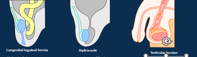 <p><strong>Congenital inguinal hernia</strong></p><ul><li><p><span>Abdominal viscera can protrude into persistent inguinal canal.</span></p></li></ul><ul><li><p style="text-align: left;"><span>Can occur in adulthood due to weakness in abdominal wall.&nbsp;</span></p></li></ul><p><strong>Hydrocoele</strong></p><ul><li><p><span>Accumulation of fluid in tunica vaginalis (peritoneal fluid or produced as the result of inflammation)</span></p></li></ul><p><strong>Testicular torsion</strong></p><ul><li><p><span>Blood supply occluded by twisting of the spermatic cord.</span></p></li></ul><p></p>