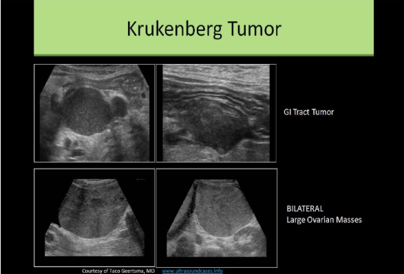 <p>C. Lymphadenopathy and Krukenberg tumor of the ovary</p><p>A Krukenberg tumor of the ovary is a metastatic tumor most commonly from a GI primary. Lymphadenopathy refers to the enlargement of lymph nodes. This is a common finding in the area of a malignancy. The liver should also be evaluated for metastasis in cases of Krukenberg tumor formation.</p>