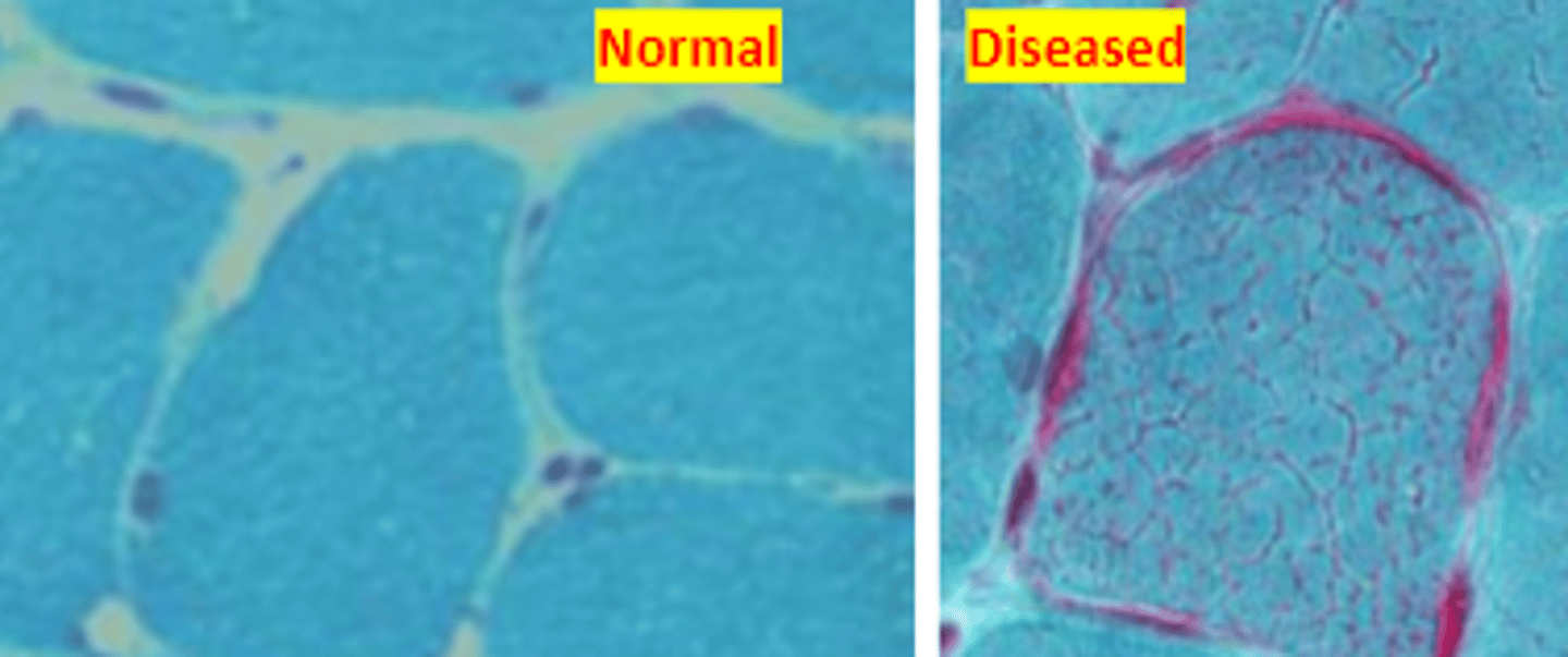 <p>Muscle biopsy with a ____ can be used to diagnose chronic progressive ophthalmoplegia as it will show "ragged red" fibers between myfibrils</p>