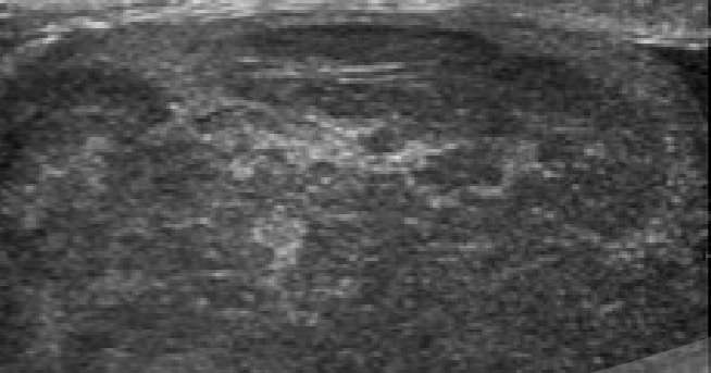 <p>Irregular or mixed echo pattern</p>