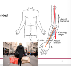 <p>The angle between the humerus and ulna when the arm is in anatomical position.</p><p>•Normal cubitus valgus (Extended elbow)</p><p>Axis of humerus to long axis of forearm: carrying angle</p>