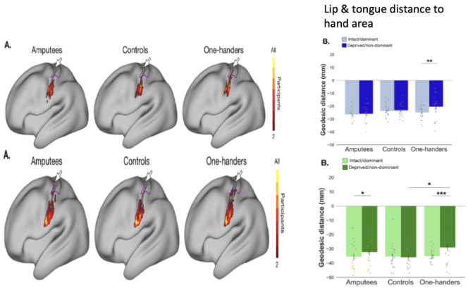 <ul><li><p>clear separation between the different areas</p></li><li><p>a group where a hand was amputated later in life, and a group where they never had a hand (grew up without a hand)&nbsp;</p></li><li><p>found the amputees have a similar somatoptic map to the control</p></li><li><p>the "one-handers" had other areas taking over those previously occupied areas of the brain</p></li><li><p><span>the distances are selectively&nbsp;shorter in amputees&nbsp;on the side that is missing</span></p></li><li><p><span>the effect is consistently stronger in the group of "one-handers"</span></p></li></ul><p></p>