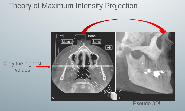 <p>-method produces a “pseudo” 3D image by evaluating each voxel value along an imaginary projection ray from the observer’s eyes within the data set and then representing only the highest value as the display value</p><p>-projection ray identified throughout the entire volumetric data set, along which individual voxels are identified, each with varying grayscale intensity corresponding to various tissue densities</p><p>-MIP algorithm selects only those values along the projection ray with the highest values (usually corresponding to bone)</p><p>-represents only one pixel on the resultant image</p>