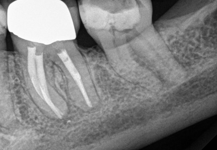 <p>What is this anatomical image you should see in a mandibular molar radiograph?</p>