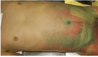 <p></p><p>Questions</p><ol><li><p>What postmortem change is characterized by a greenish discoloration of the skin on the anterior abdominal wall?</p></li><li><p>What is the typical timeframe for this specific postmortem change to appear?</p></li></ol><p></p><p></p>