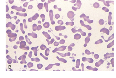 <p>What is the <strong>etiology of Hereditary pyropoikilocytosis?</strong></p>