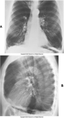<p>This x-ray image indicates what pathology?</p>