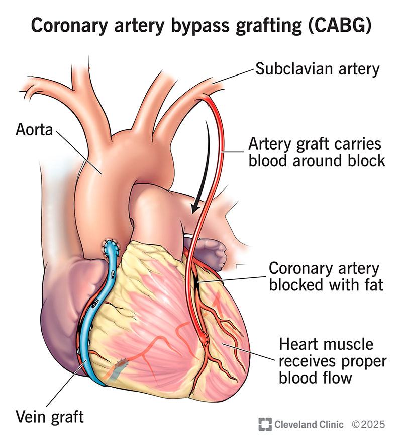 <p>“cabbage”</p><p><span>Fat (plaque) build up, restricts blood to heart…take a healthy blood vessel (graft) from body…attach above and below the blocked area = new "detour"</span></p>