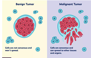 <p>Describes a neoplasm that <span style="color: red;">stays localized </span>in one place. These cells are not cancerous and will not spread.</p>