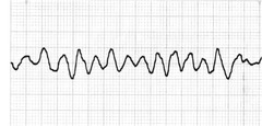 <p>ventricular fibrillation, v-fib</p>