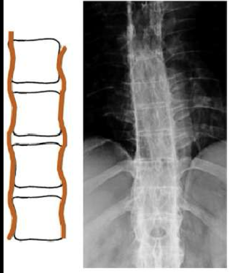 <p>What finding of AS is found in this image</p>