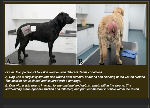 <p>Two dogs sustain similar contaminated skin wounds.</p><p>Dog A: Wound is surgically cleaned, all debris removed, and sutured. The wound heals over 10-14 days with diminishing redness and swelling. Histology at day 14 shows restoration of normal tissue architecture with a small fibrotic scar.</p><p>Dog B: Wound is cleaned superficially but a fragment of foreign material (plant awn) remains embedded. Redness and swelling persist for weeks. Histology at day 14 shows macrophage and lymphocyte infiltration, progressive connective tissue deposition, and loss of normal tissue architecture in the affected region.</p><p></p><p><strong>Which interpretation best explains the difference in inflammatory outcome between Dog A and Dog B?</strong></p><p>a. Dog A's immune system is more effective than Dog B's, which is why inflammation resolved faster</p><p>b. Removal of debris in Dog A eliminated the inflammatory stimulus, allowing vascular permeability to normalize and tissue repair to proceed; retained debris in Dog B provides a persistent foreign body stimulus that maintains mononuclear cell recruitment and progressive tissue remodeling</p><p>c. Dog A's wound was sutured, which increased local blood pressure and forced inflammatory fluid out of the tissue faster</p><p>d. Dog B developed chronic inflammation because the immune response became self-sustaining and self-amplifying regardless of the original stimulus</p>