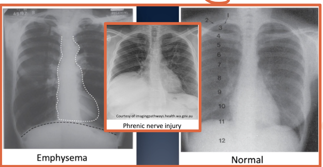 <ul><li><p>Any condition that increases lung volume</p></li><li><p>Ex: Emphysema or large pleural effusions</p></li></ul><p></p>