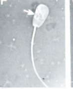 <p>What is this? Normal or abnormal sperm?</p>