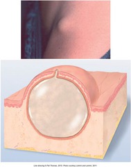 <p>a closed, sac-like pocket of tissue anywhere in the body that can be filled with fluid, pus, air, or other materials</p>