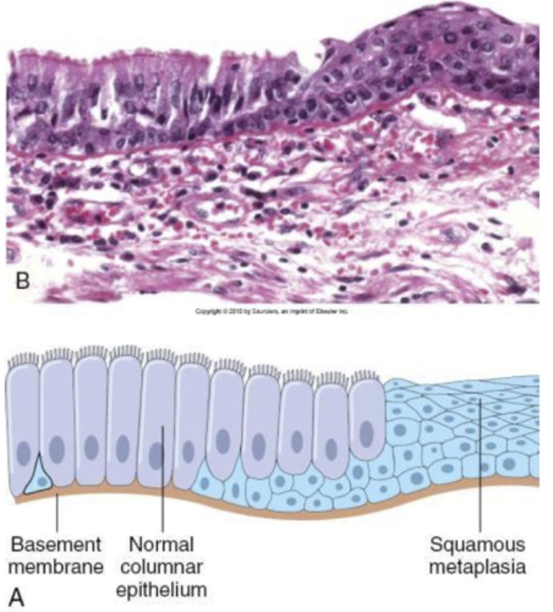 <p>when one mature cell type is replaced by a different mature cell type. ex: change in respiratory tracts in cigarette smokers.</p>