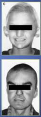 <p>-Hypodontia </p><p>-Hypohidrosis (reduced sweating) </p><p>-Hypotrichosis (sparse hair) </p><p>-prominent forehead</p><p>-wide eyebrows</p><p>-saddle-shaped nose</p><p>-thick everted lips</p><p>-dry skin</p><p>-fine sparse hair</p>