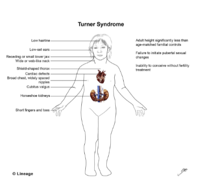 <ul><li><p>Genotype: XO</p></li><li><p>1 in 2500 female births</p></li><li><p>20% do not survive to birth</p></li><li><p>75% caused by abnormal sperm</p></li></ul><p></p>