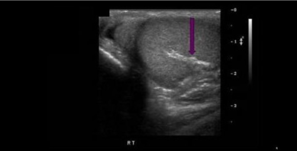 <p>The structure indicated by the arrow is composed of:</p><p>A. microvessels carrying venous blood</p><p class="p1">B. loops of spermatic cord</p><p class="p1">C. folds of tunica vaginalis</p><p class="p1">D. folds of tunica albuginea</p>