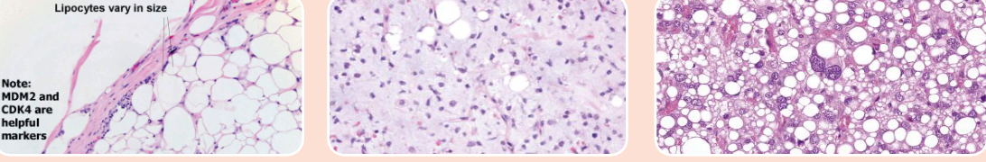 <ul><li><p>lipoma</p></li><li><p>liposarcoma</p><ul><li><p><u>well-differentiated</u>= indolent, mature adipocyte, <u>atypical spindle cell</u> → <strong>MDM2 + CDK4 </strong>gene amplification FISH</p></li><li><p><u>myxoid</u>= abundant matrix → <strong>t(2:16) + FUS-DDIT3</strong> gene amplification FISH</p></li><li><p><u>pleomorphic</u>= aggressive; anaplastic cell, bizarre nuclei, admixed <strong>lipoblast </strong>→ complex karyotype</p></li></ul></li></ul><p></p>