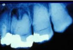 <p><span>Radiographic features: roots are extremely short, pulps are almost completely obliterated</span></p>