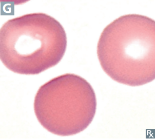 <p>Small, spherical RBCs without central pallor</p>