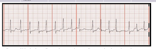 <p>Identify the above waveform:</p><p>a. Atrial flutter</p><p>b. Atrial fibrillation</p><p>c. SVT or atrial tachycardia</p><p>d. sinus tachycardia</p>