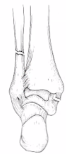 <p>What fracture is this?</p>