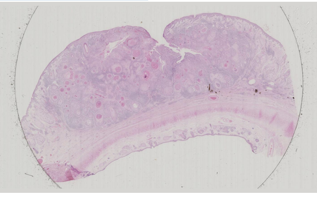 <p>Skin: Squamous Cell Carcinoma</p>