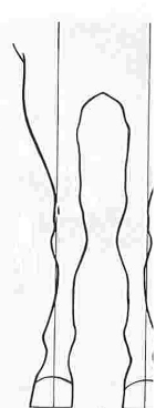 <p>may predispose to splints</p>
