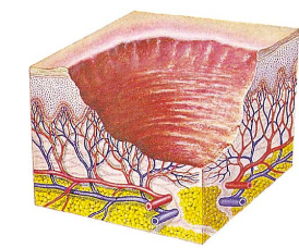 <ul><li><p>erosion from epiderm. to derm.</p></li><li><p>concave</p></li></ul><p></p>