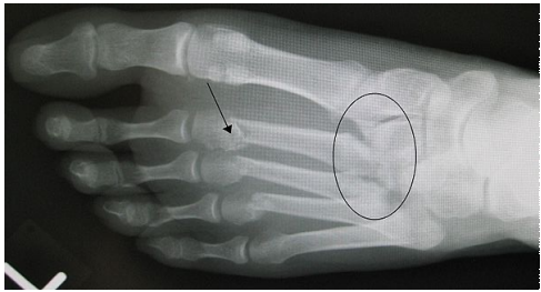 <p>Lisfranc injury</p>
