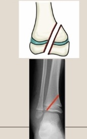 <p>Use the Salter-Harris classification system to describe the fracture pattern </p>